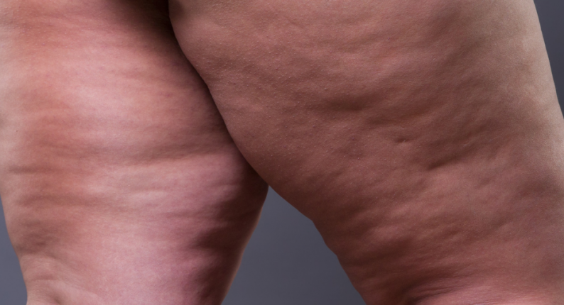 cellulit_stop_lpg_alliance_masaz_podcisnieniowy_endermologia_marta_wojtowicz_mokotow (3)
